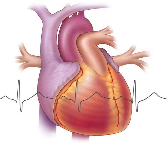 Показания к радиочастотной абляции сердца.